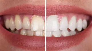 دانتوں کی زردی دور کرنے کے آسان گھریلو طریقے